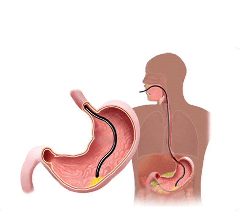 Endoscopia-Digestiva-Alta